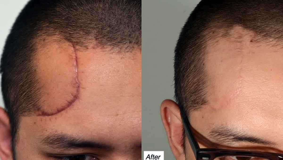 ترمیم اسکار جراحی