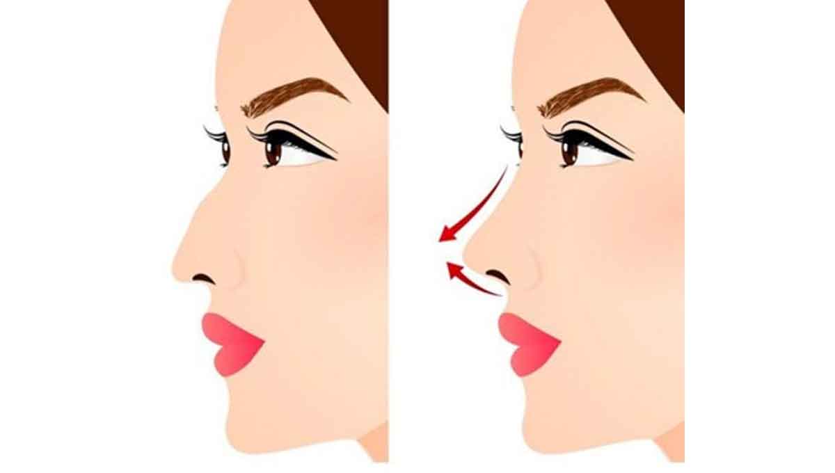 رینوپلاستی