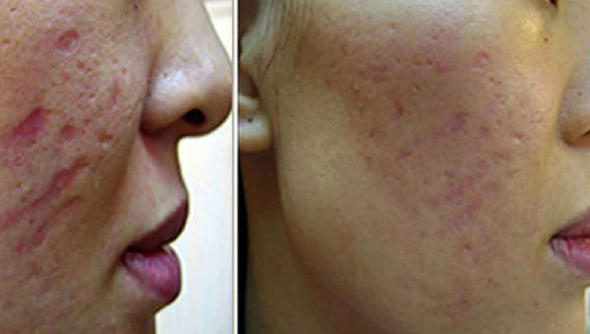 ترمیم اسکارهای پوستی