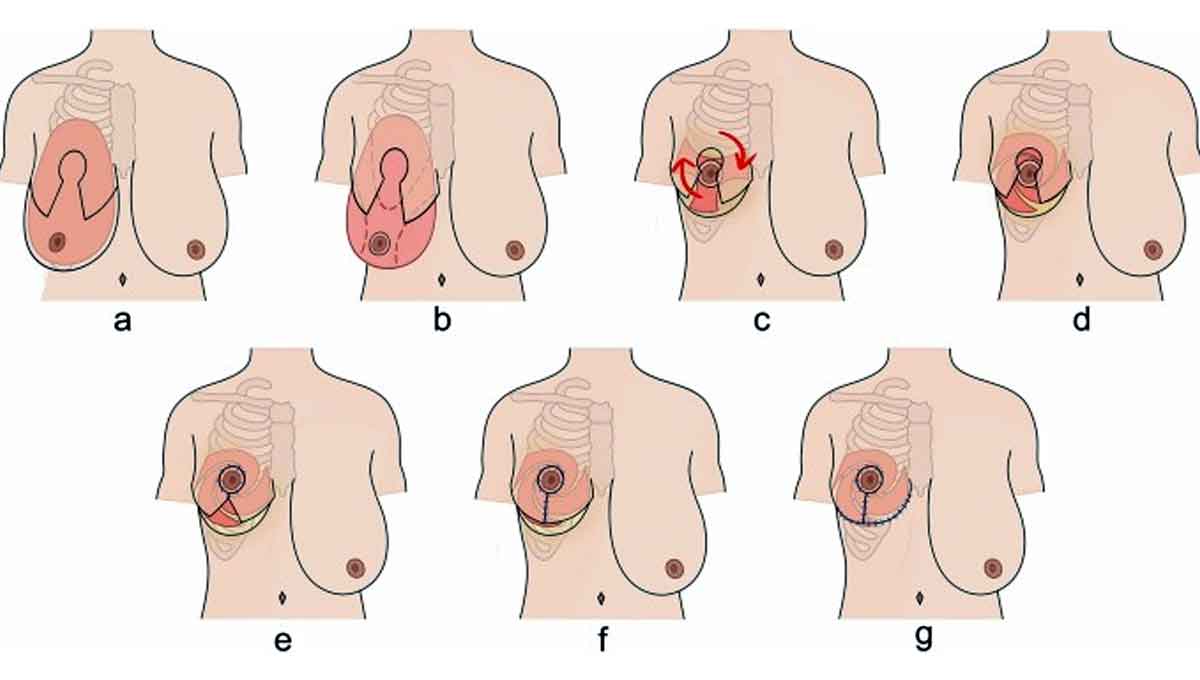 ماموپلاستی
