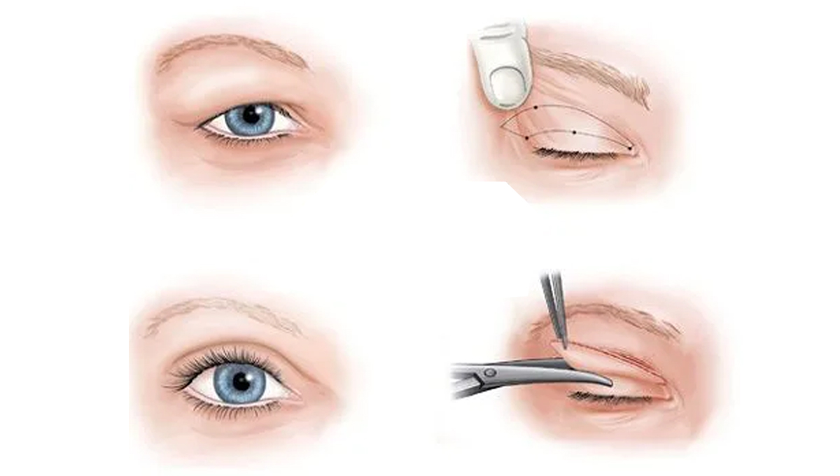 بلفاروپلاستی