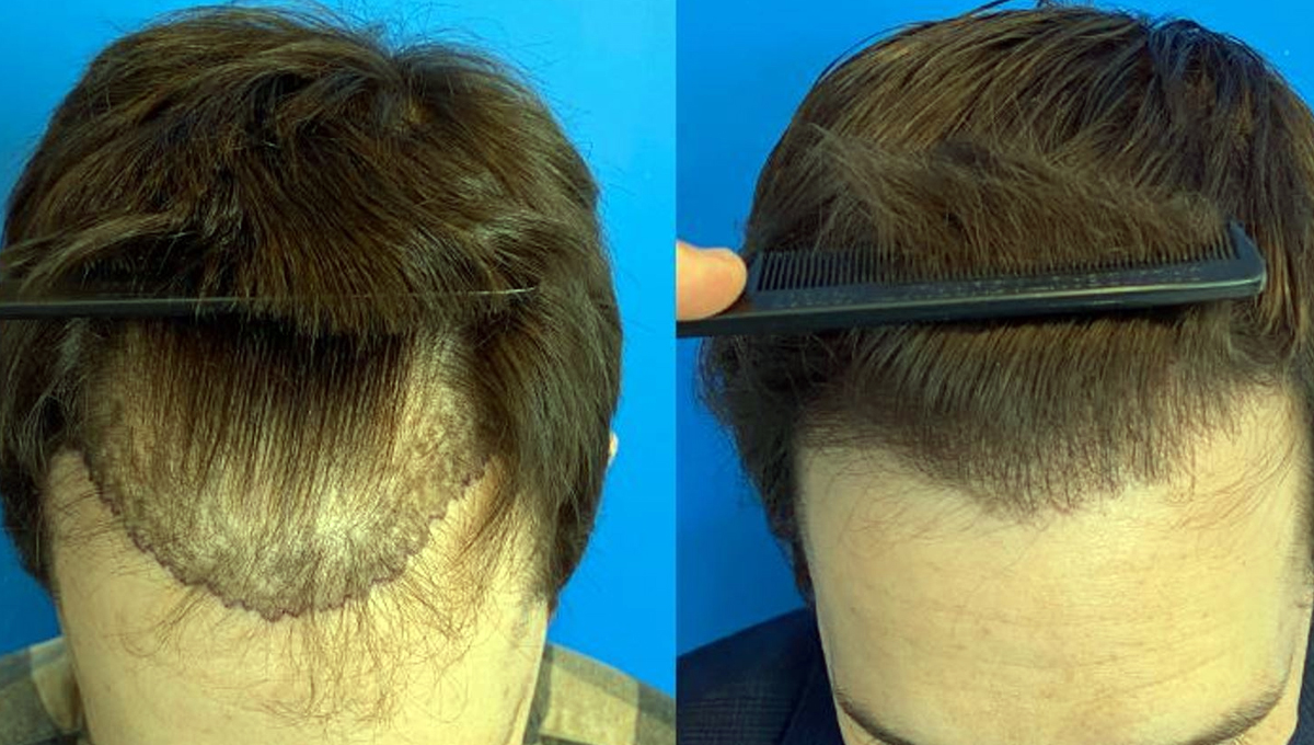 کاشت و ترمیم مو