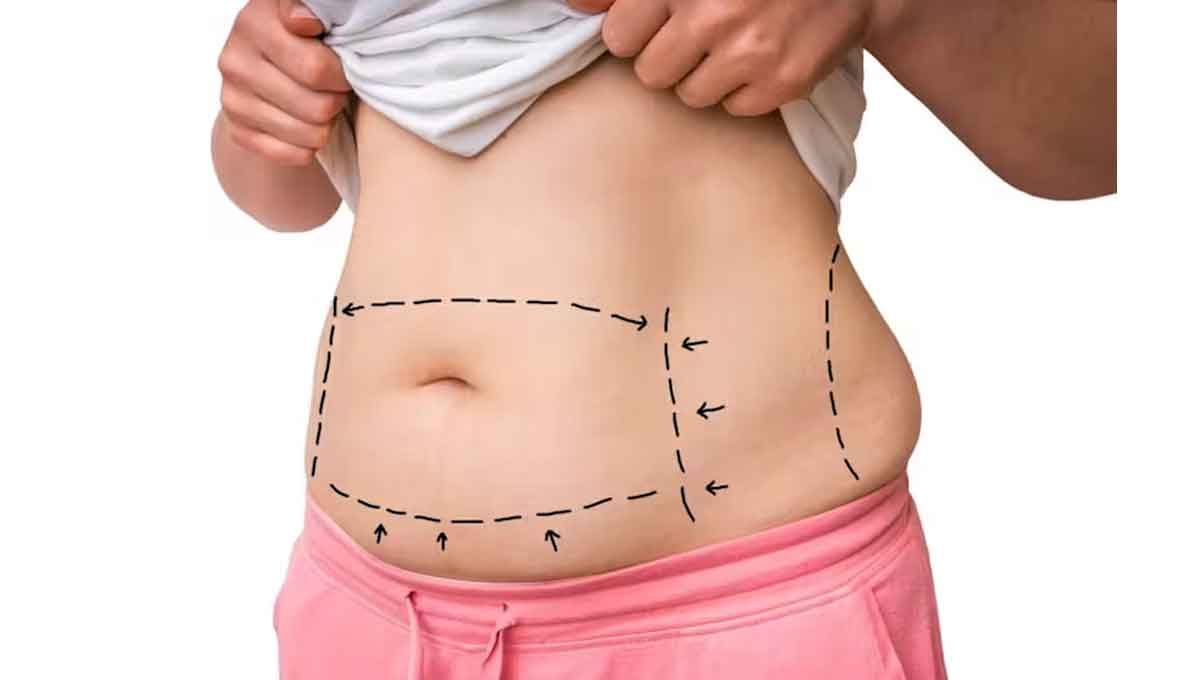 ابدومینوپلاستی