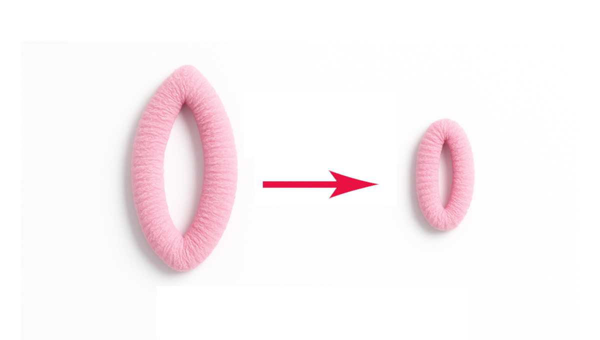 پرینوپلاستی